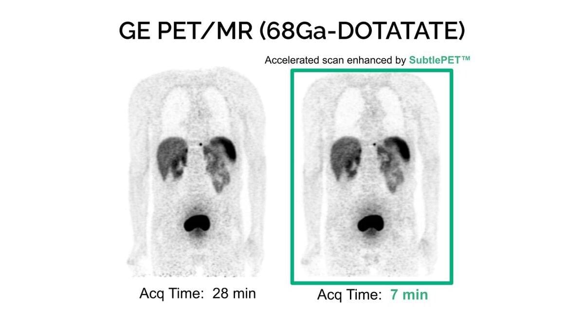 SubtlePET 2.0 Gets CE Mark • APPLIED RADIOLOGY